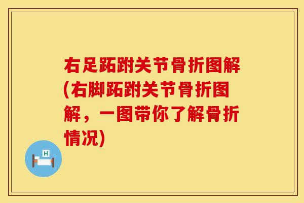 右足跖跗关节骨折图解(右脚跖跗关节骨折图解，一图带你了解骨折情况)