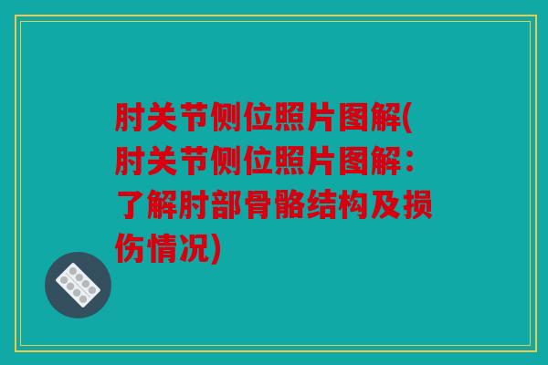 肘关节侧位照片图解(肘关节侧位照片图解:了解肘部骨骼结构及损伤情况) 肘关节侧位照片图解(肘关节侧位照片图解:了解肘部骨骼结构及损伤情况)